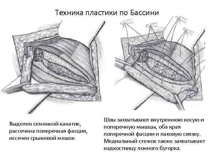 Техника пластики по Бассини Выделен семенной канатик, рассечена поперечная фасция, иссечен грыжевой мешок Швы