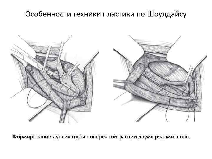 Пластика по краснобаеву пахового канала