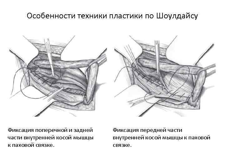 Особенности техники пластики по Шоулдайсу Фиксация поперечной и задней части внутренней косой мышцы к
