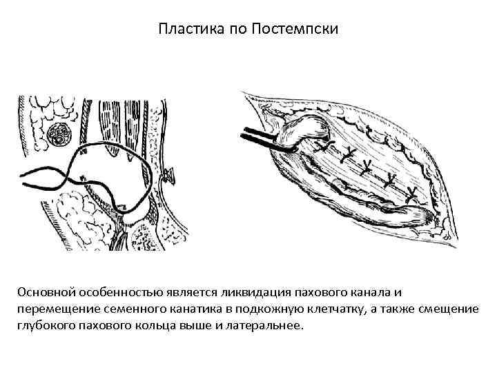 Пластика по Постемпски Основной особенностью является ликвидация пахового канала и перемещение семенного канатика в