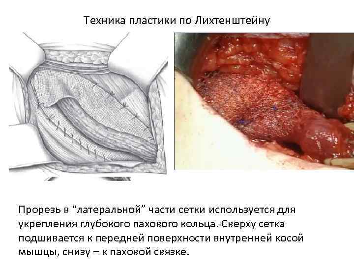 Техника пластики по Лихтенштейну Прорезь в “латеральной” части сетки используется для укрепления глубокого пахового