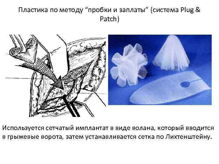 Пластика по методу “пробки и заплаты” (система Plug & Patch) Используется сетчатый имплантат в