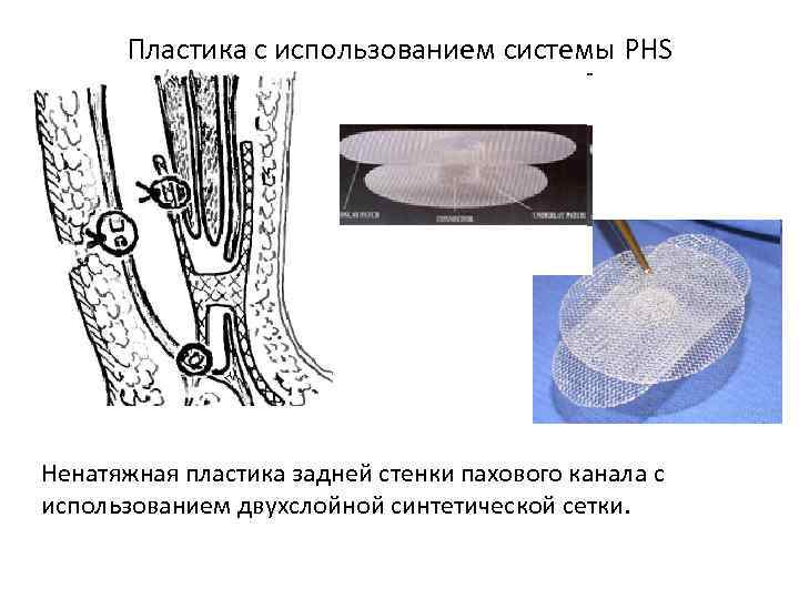 Пластика с использованием системы PHS Ненатяжная пластика задней стенки пахового канала с использованием двухслойной