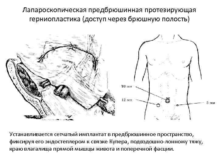 Лапароскопическая предбрюшинная протезирующая герниопластика (доступ через брюшную полость) Устанавливается сетчатый имплантат в предбрюшинное пространство,