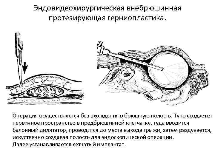 Эндовидеохирургическая внебрюшинная протезирующая герниопластика. Операция осуществляется без вхождения в брюшную полость. Тупо создается первичное