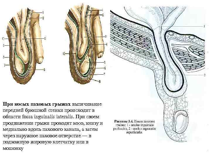При косых паховых грыжах выпячивание передней брюшной стенки происходит в области fossa inguinalis lateralis.
