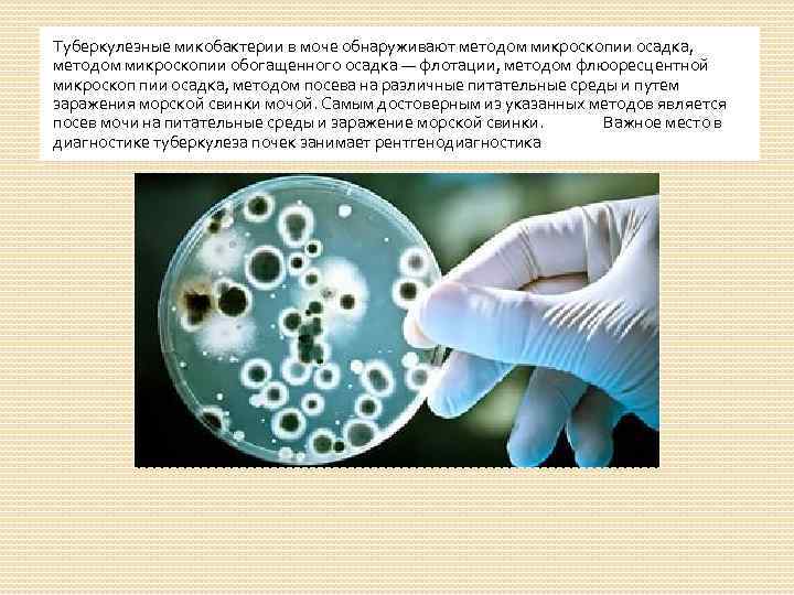 Туберкулезные микобактерии в моче обнаруживают методом микроскопии осадка, методом микроскопии обогащенного осадка — флотации,