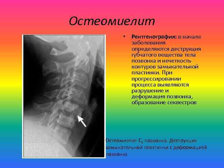 Остеомиелит • Рентгенография: в начале заболевания определяются деструкция губчатого вещества тела позвонка и нечеткость