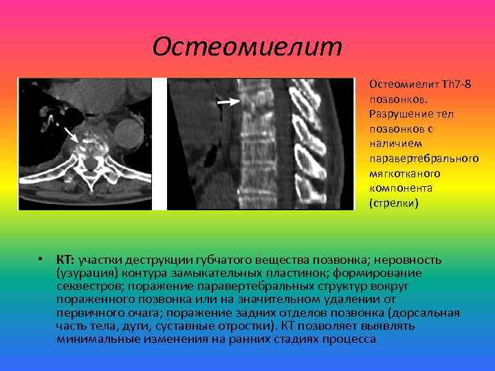 Остеомиелит Th 7 -8 позвонков. Разрушение тел позвонков с наличием паравертебрального мягкотканого компонента (стрелки)