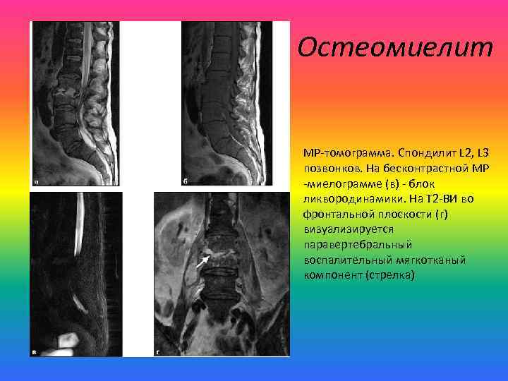 Остеомиелит МР-томограмма. Спондилит L 2, L 3 позвонков. На бесконтрастной МР -миелограмме (в) -