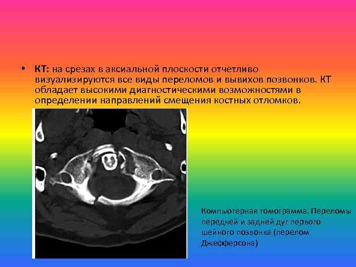  • КТ: на срезах в аксиальной плоскости отчетливо визуализируются все виды переломов и