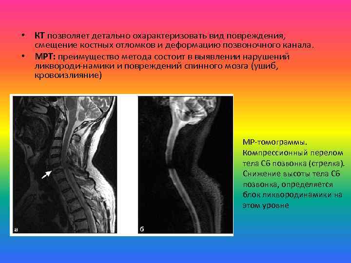  • КТ позволяет детально охарактеризовать вид повреждения, смещение костных отломков и деформацию позвоночного