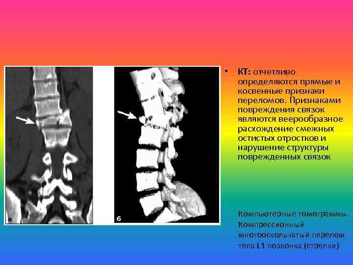  • КТ: отчетливо определяются прямые и косвенные признаки переломов. Признаками повреждения связок являются