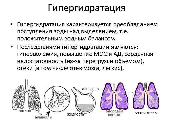 Гипергидратация • Гипергидратация характеризуется преобладанием поступления воды над выделением, т. е. положительным водным балансом.