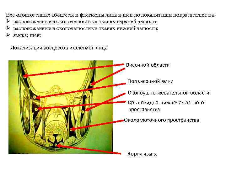 Все одонтогенные абсцессы и флегмоны лица и шеи по локализации подразделяют на: Ø расположенные