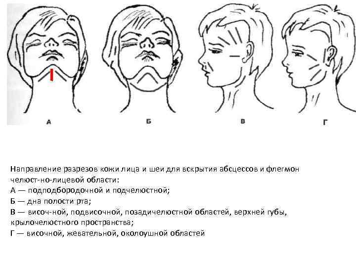 Направление разрезов кожи лица и шеи для вскрытия абсцессов и флегмон челюст но лицевой