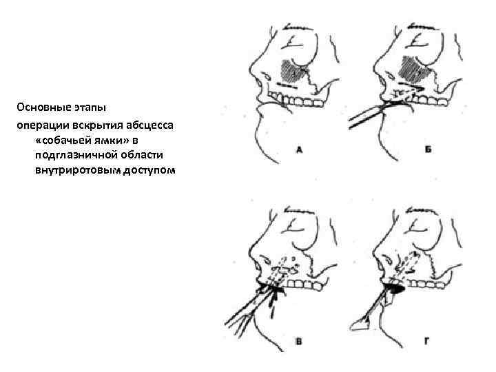 Основные этапы операции вскрытия абсцесса «собачьей ямки» в подглазничной области внутриротовым доступом 