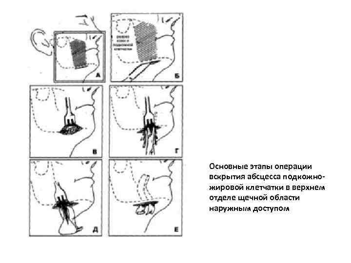 Основные этапы операции вскрытия абсцесса подкожножировой клетчатки в верхнем отделе щечной области наружным доступом