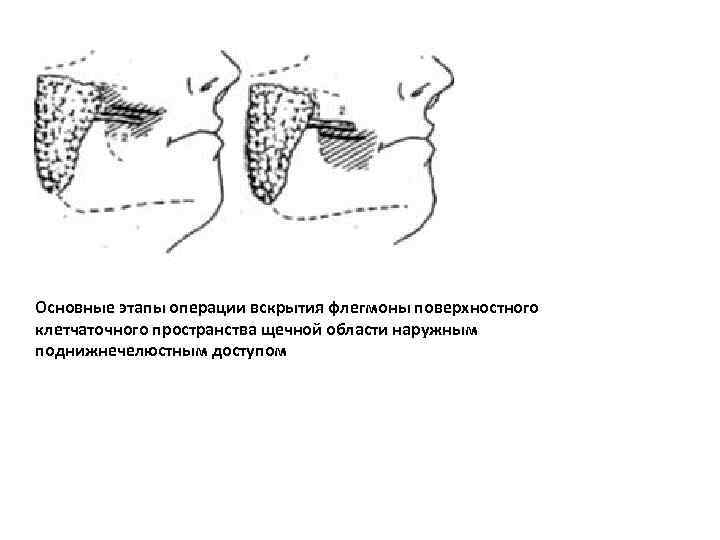 Основные этапы операции вскрытия флегмоны поверхностного клетчаточного пространства щечной области наружным поднижнечелюстным доступом 