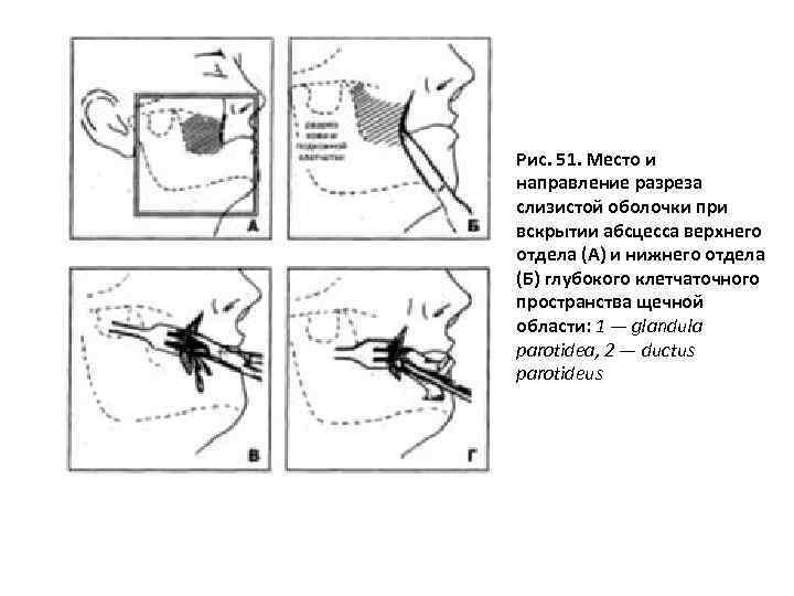 Рис. 51. Место и направление разреза слизистой оболочки при вскрытии абсцесса верхнего отдела (А)