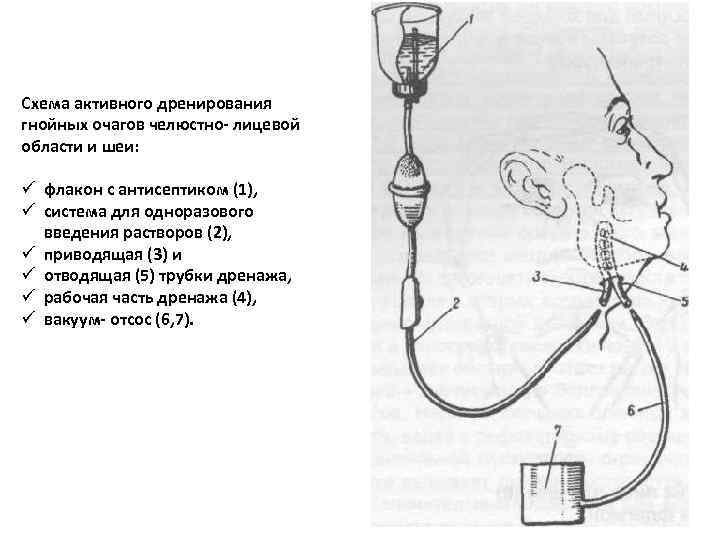 Схема активного дренирования гнойных очагов челюстно- лицевой области и шеи: ü флакон с антисептиком