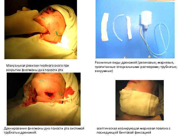 Мануальная ревизия гнойного очага при вскрытии флегмоны дна полости рта Дренирование флегмоны дна полости