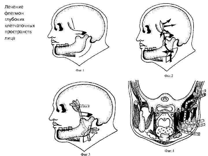 Лечение флегмон глубоких клетчаточных пространств лица 