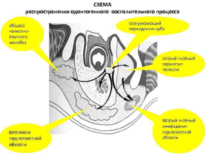 Абсцесс челюстно язычного желобка фото