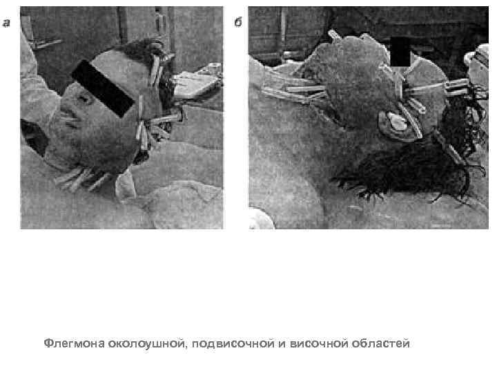 Флегмона околоушной, подвисочной и височной областей 