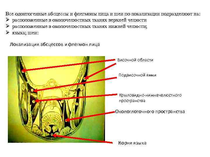 Все одонтогенные абсцессы и флегмоны лица и шеи по локализации подразделяют на: Ø расположенные