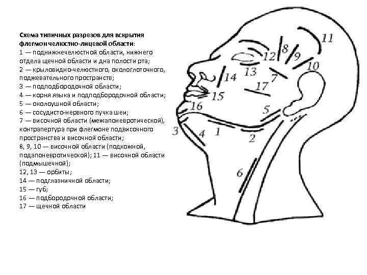 Схема типичных разрезов для вскрытия флегмон челюстно лицевой области: 1 — поднижнечелюстной области, нижнего