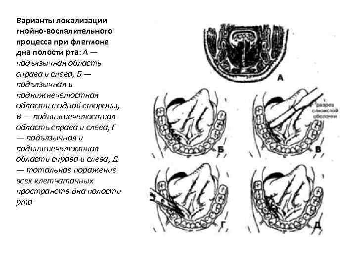 Варианты локализации гнойно воспалительного процесса при флегмоне дна полости рта: А — подъязычная область