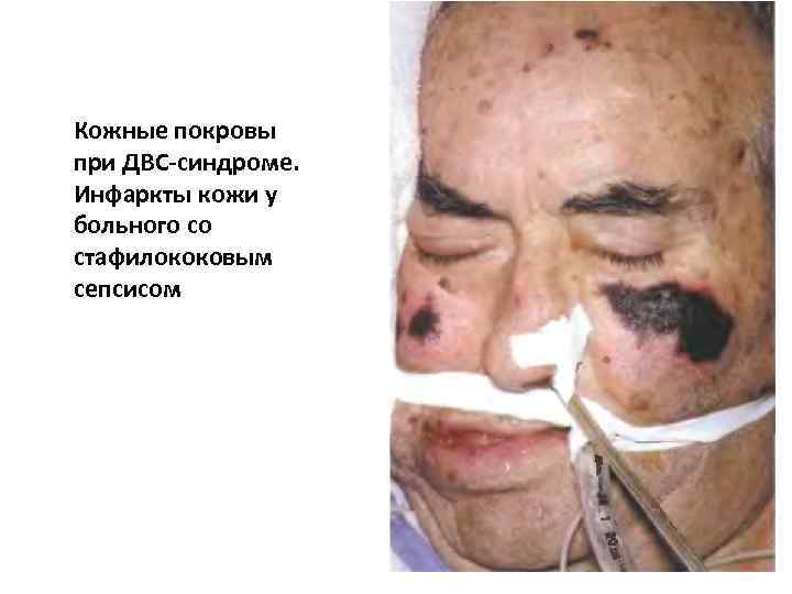 Кожные покровы при ДВС синдроме. Инфаркты кожи у больного со стафилококовым сепсисом 