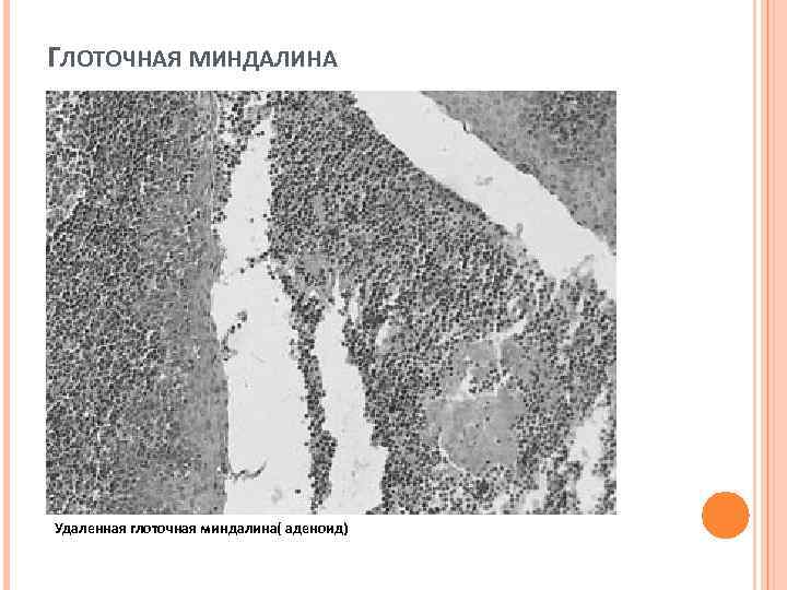 ГЛОТОЧНАЯ МИНДАЛИНА Удаленная глоточная миндалина( аденоид) 