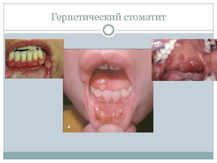 Герпетический стоматит 