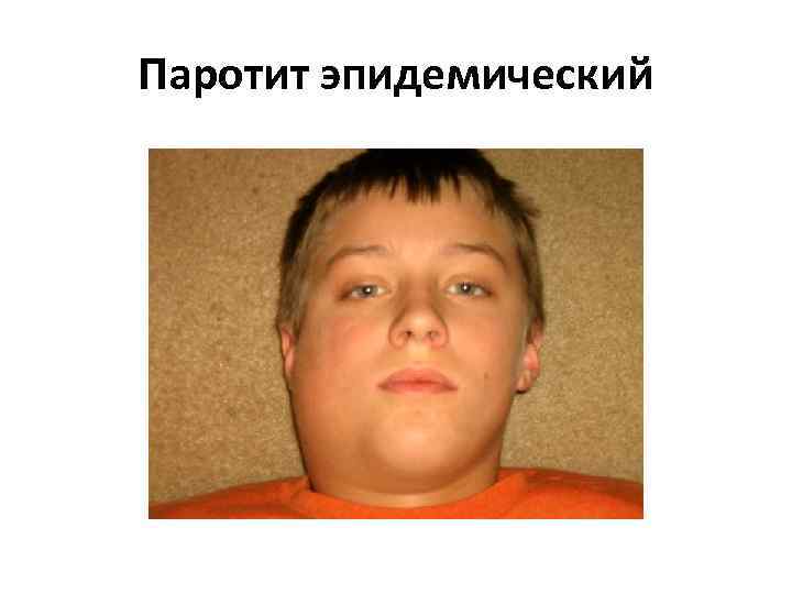 Паротит эпидемический 