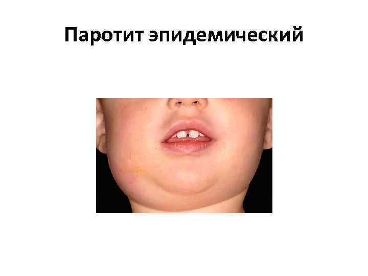 Паротит эпидемический 