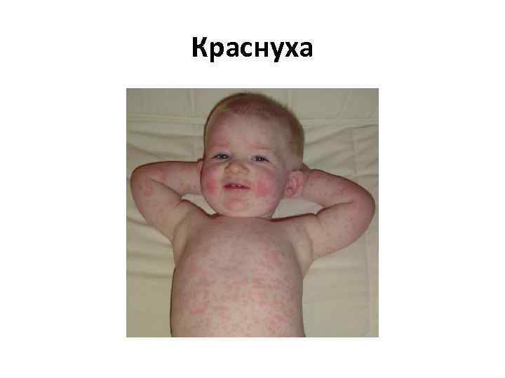 Краснуха 