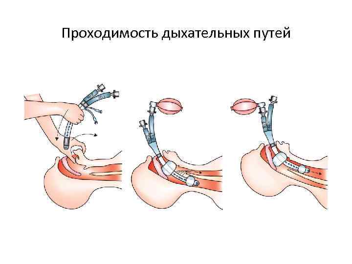 Проходимость дыхательных путей 