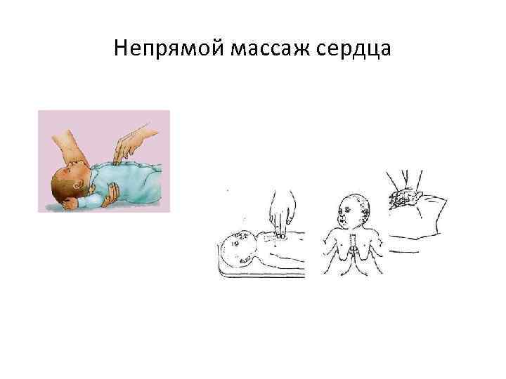 Непрямой массаж сердца 