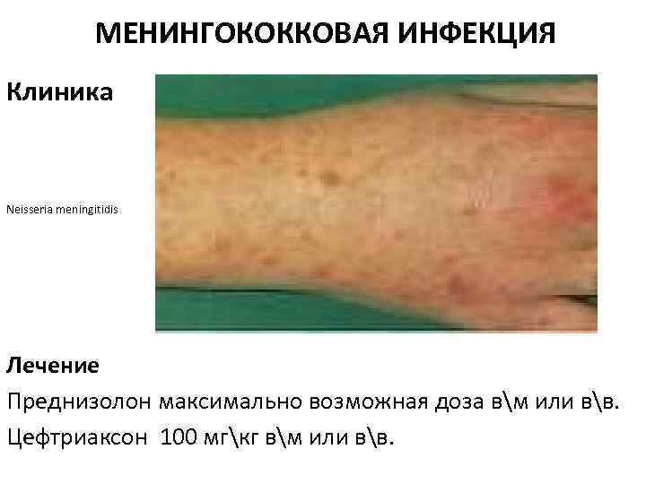 МЕНИНГОКОККОВАЯ ИНФЕКЦИЯ Клиника Neisseria meningitidis Лечение Преднизолон максимально возможная доза вм или вв. Цефтриаксон
