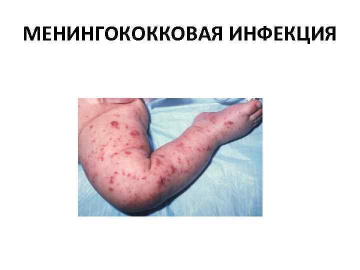 МЕНИНГОКОККОВАЯ ИНФЕКЦИЯ 