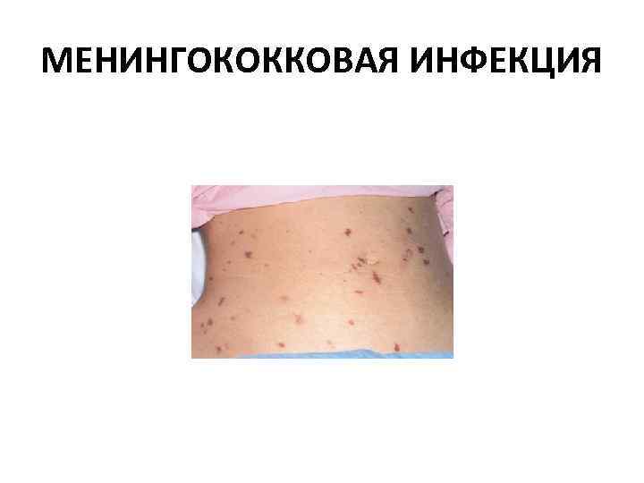 МЕНИНГОКОККОВАЯ ИНФЕКЦИЯ 