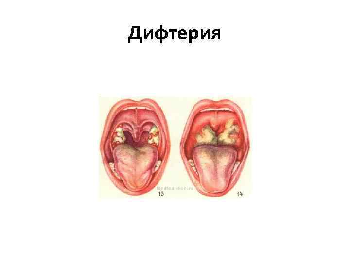 Дифтерия 