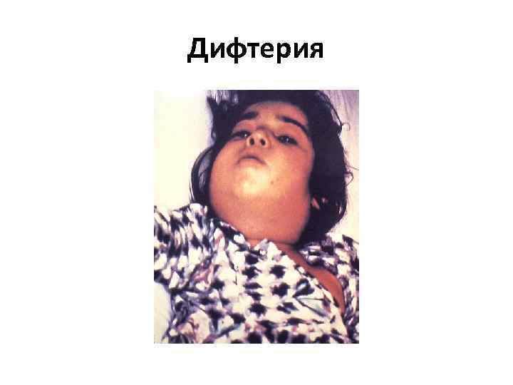 Дифтерия 