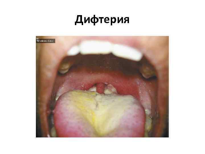Дифтерия 