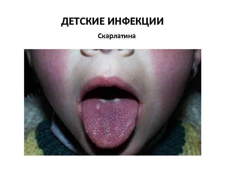ДЕТСКИЕ ИНФЕКЦИИ Скарлатина 