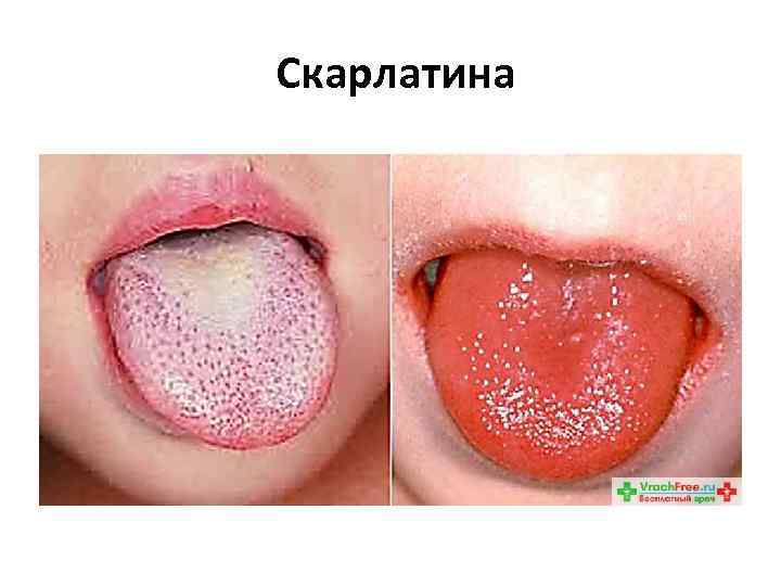  Скарлатина 