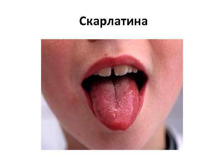  Скарлатина 