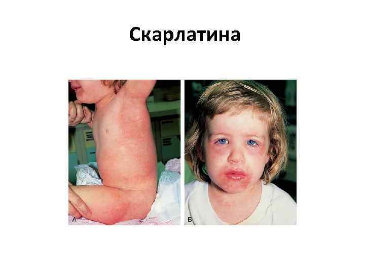  Скарлатина 